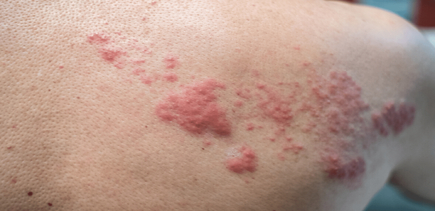 Skin Allergy Treatments