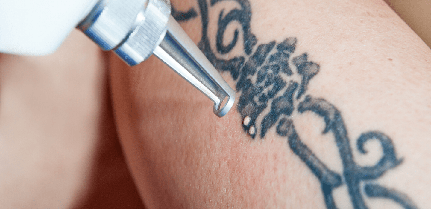 Laser Tattoo Removal