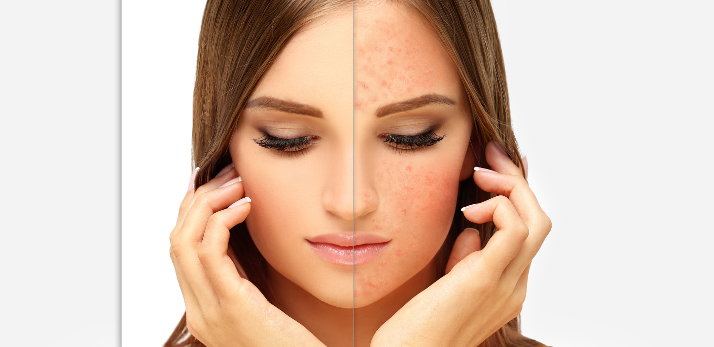 Rosacea Treatment