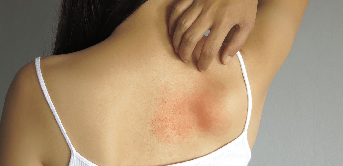 Skin Allergies and Rashes