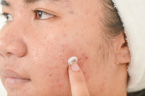 Acne Medical Treatment_Mayra