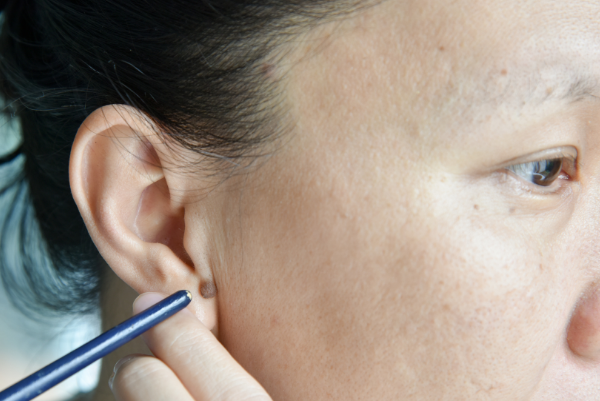 Ear Keloid Treatment_Mayra