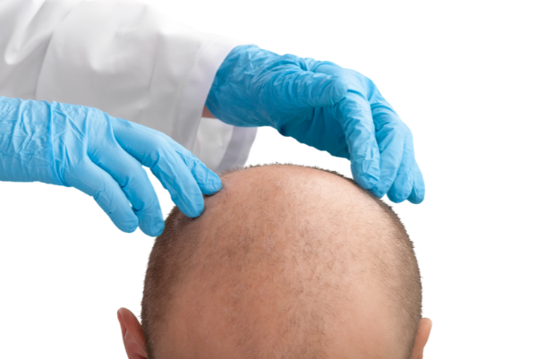 Hair Fall Treatment - Get the best Hair loss Treatments in Indore