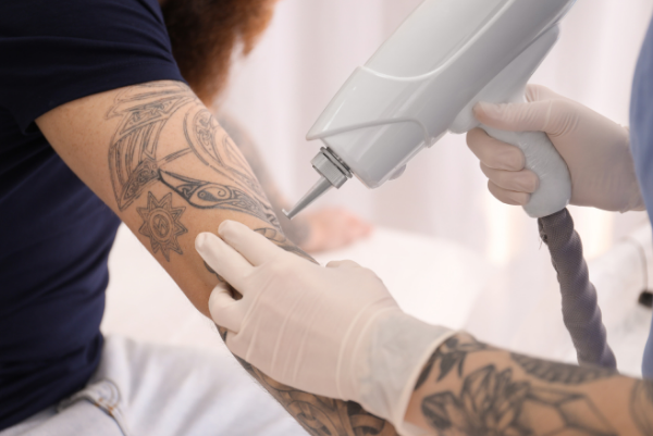 Laser Tattoo Removal: How it Works, Procedure and After Care