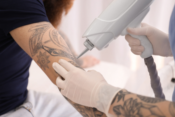 Tattoo removal treatment in Silchar